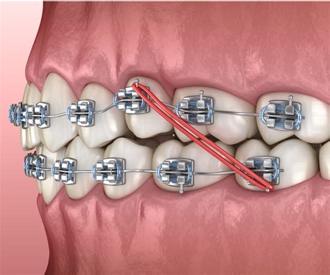 metal brackets act as springs buttons|Parts of Braces .